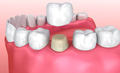 Dental Crowns